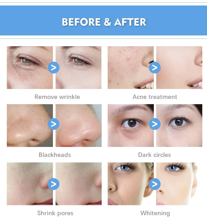 7 In 1 Smart Ice Blue Hydra oxyge Dermabrasion Facial Mahcine Skin Cleaning Skin Analyzer Dermabrasion Facial Aquafacial